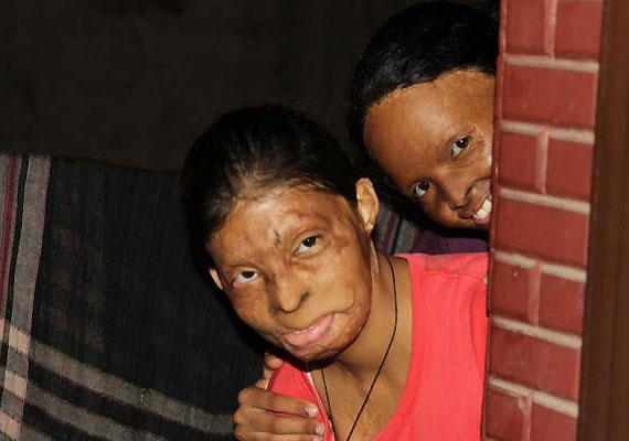 acid attack victims living in india