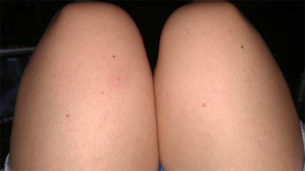 Moles on thighs