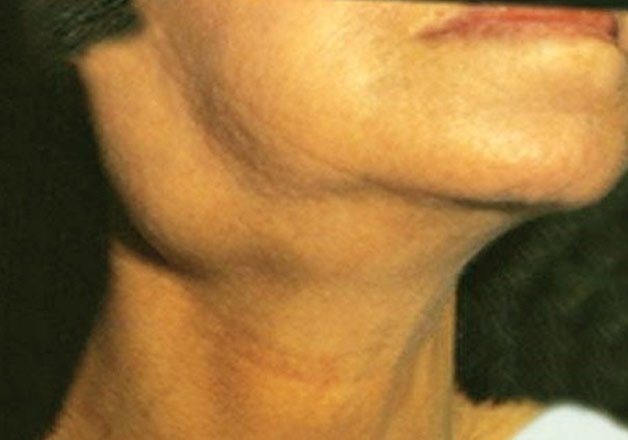 Swollen Neck Glands May Indicate Cancer 