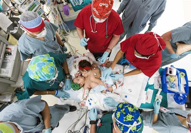 US surgeons separate 10-month-old conjoined twin girls