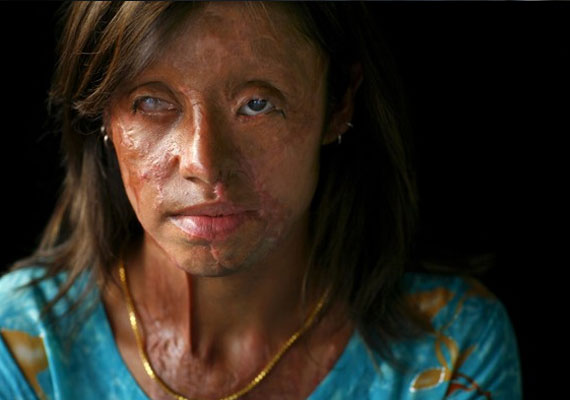 india acid attack victim true story